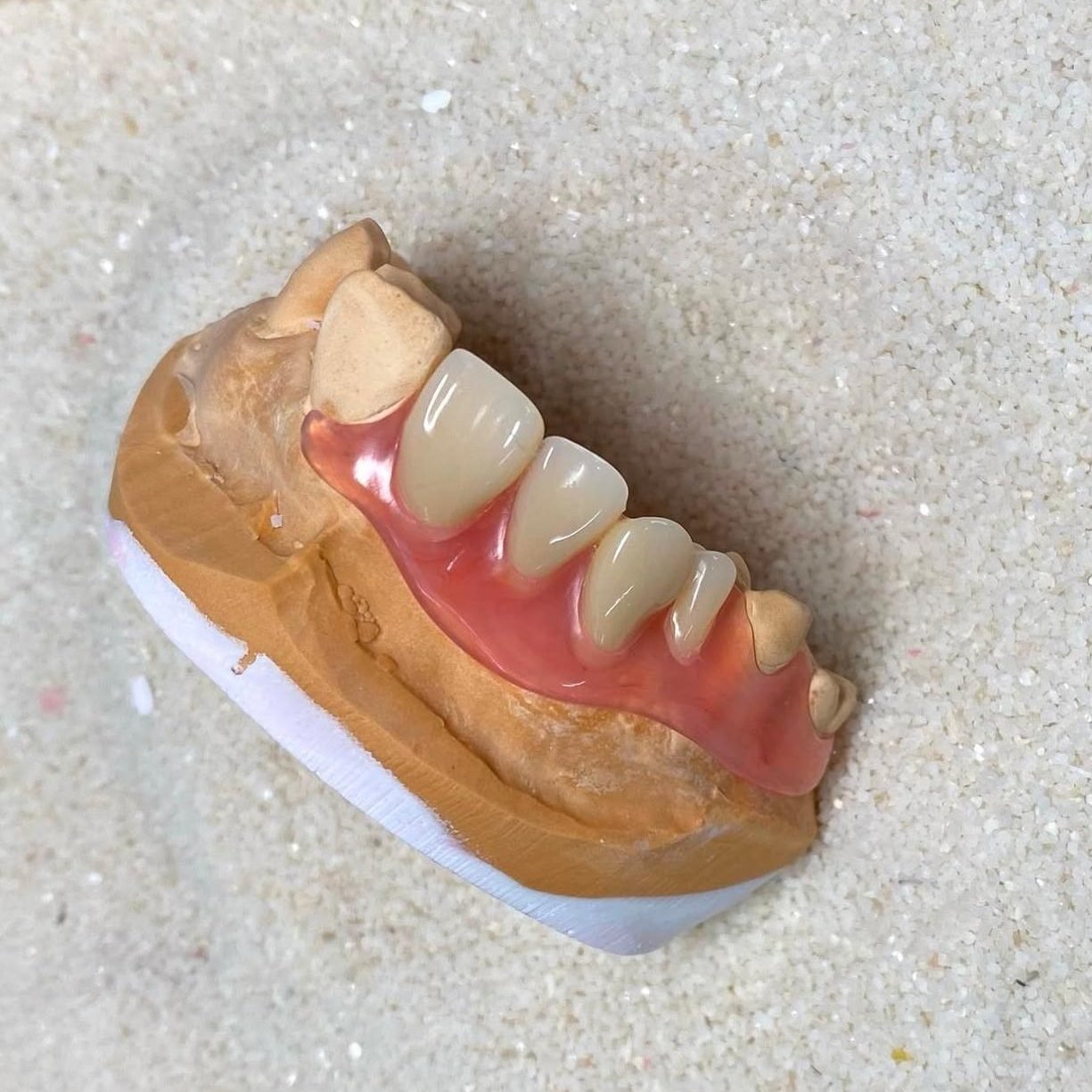 Prótesis parcial removible fabricada por Sabogal Dental