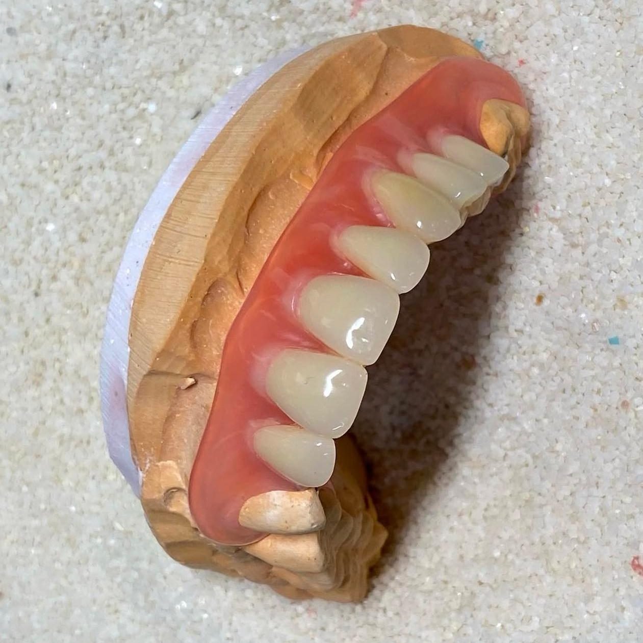 Prótesis total superior fabricada por Sabogal Dental