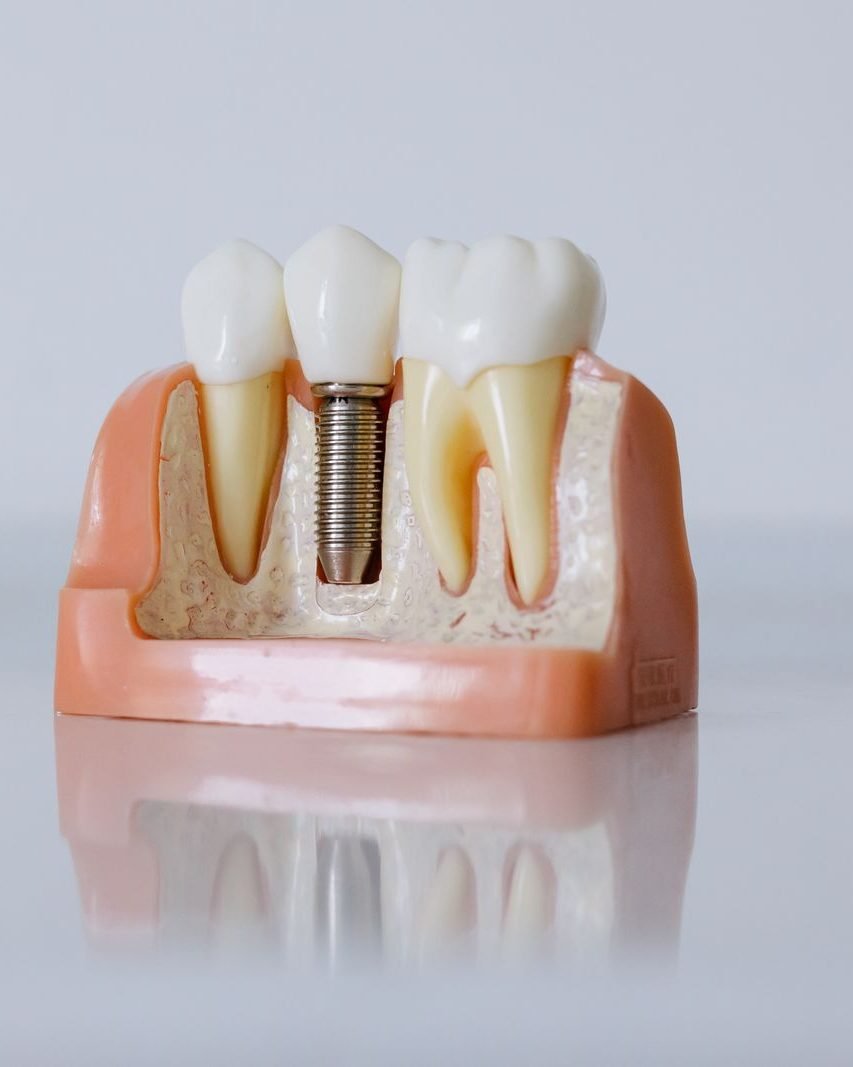 Modelo digital de implante dental con precisión milimétrica