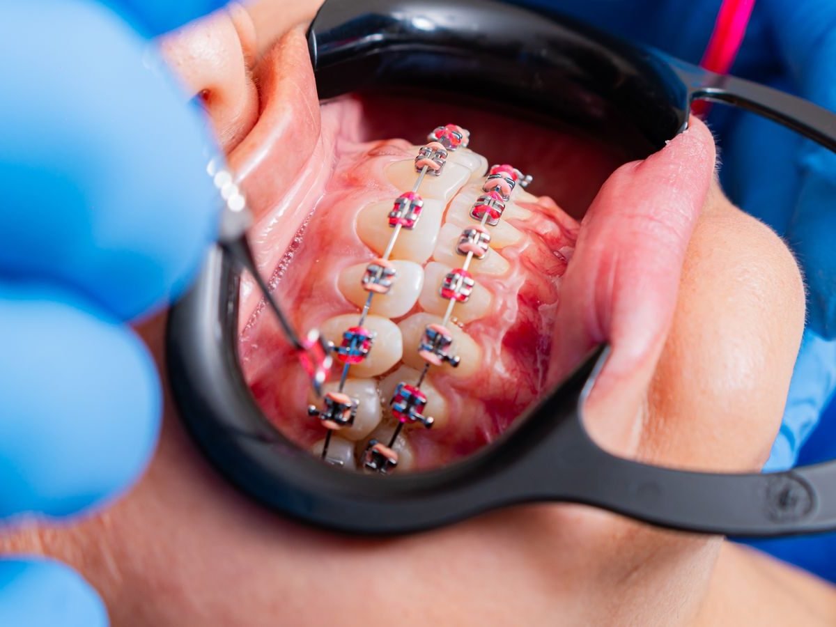Ortodoncia con brackets revisada por un especialista